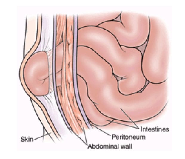 hernia-surgery